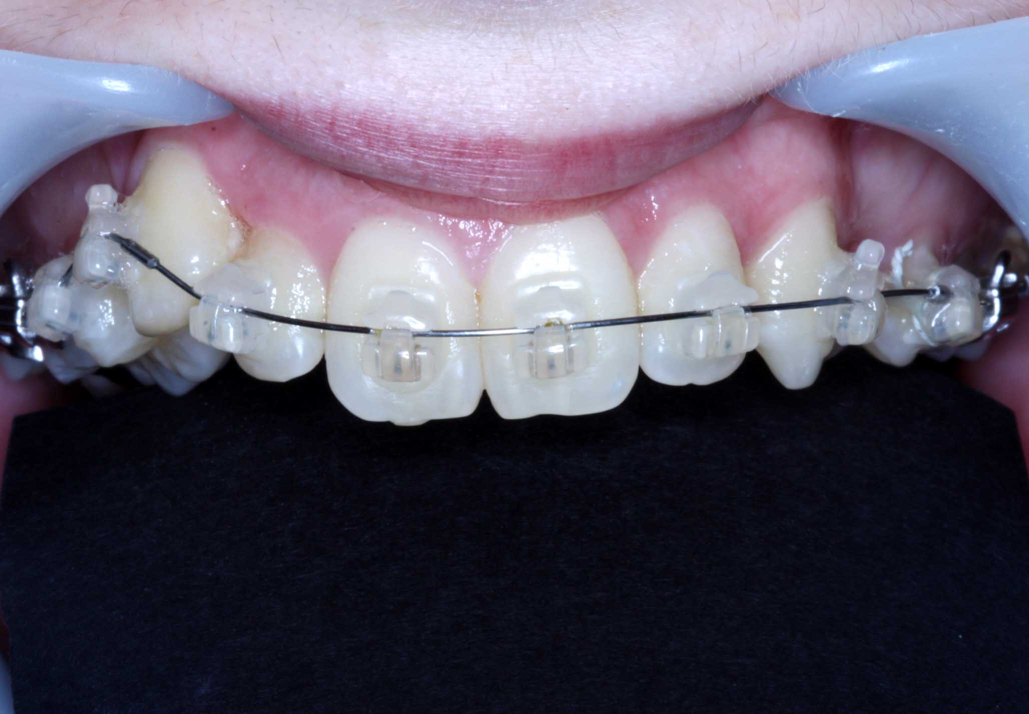 Swords Dublin Orthodontist Services & Procedures Orthodontist IE