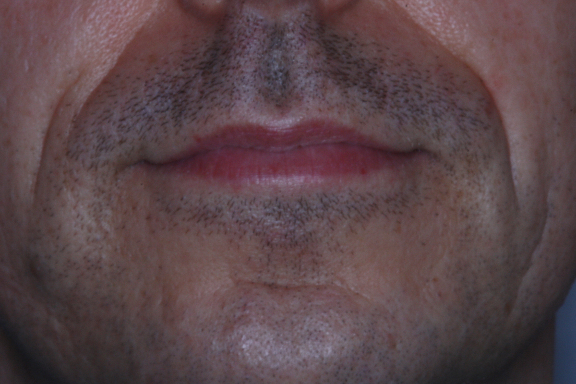 Dr Stephen Murray from Swords Orthodontics and Movember day two