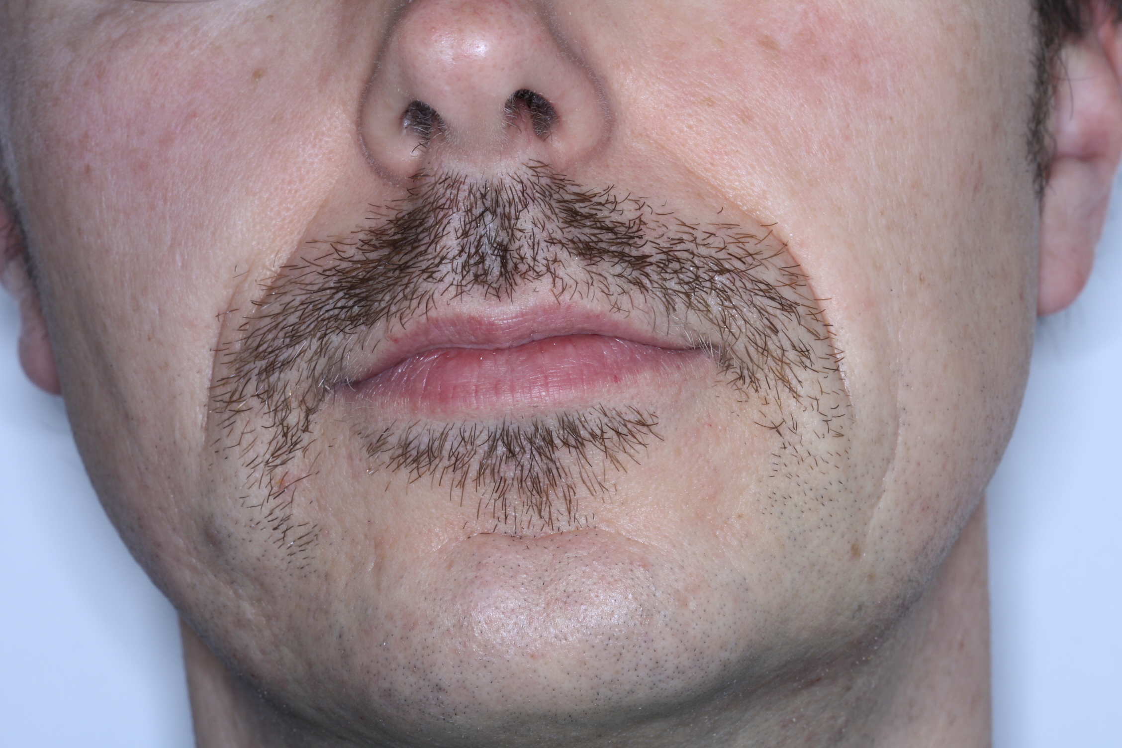 Dr Stephen Murray from Swords Orthodontics Movember Day 12