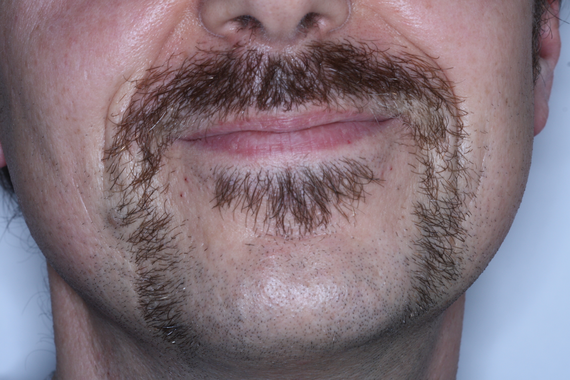 Mo close up of Dr Stephen Murray from Swords Orthodontics on Movember 25th