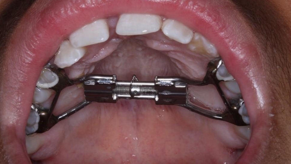 What is a Rapid Maxillary Expander? Orthodontic Care for PreTeens