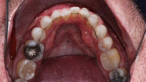 A Broken Fixed Orthodontic Retainer